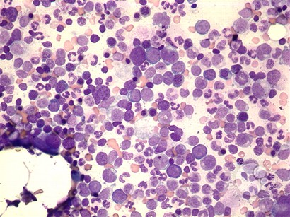 AML with inv(3) - 1.