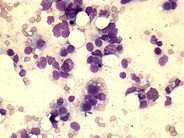 Extranodal NK/T-cell lymphoma - 1.