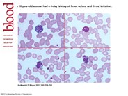 Apoptotic lymphocyte as a clue to infectious mononucleosis