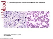 Microvascular sequestration of Plasmodium falciparum