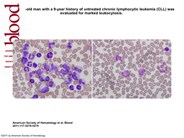 chronic leukemia vs acute leukemia