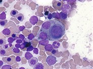 Phagocytic histiocyte - 1.