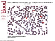 Howell-Jolly bodies in patients with chronic GVHD