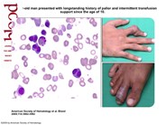 Tophaceous gout with congenital dyserythropoietic anemia