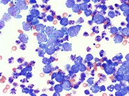 Burkitt lymphoma in ascitic fluid - 2.