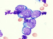 Burkitt lymphoma in ascitic fluid - 3.