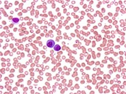 Amyloidosis: Acquired Factor X Deficiency - 3.