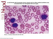 Lymphocytosis: T-cell large granular lymphocyte leukemia