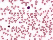 platelet clump in peripheral blood smear