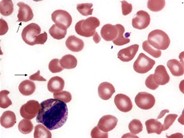 platelet clump in peripheral blood smear