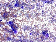 thrombotic thrombocytopenic purpura histology