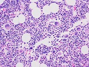 thrombotic thrombocytopenic purpura (ttp)