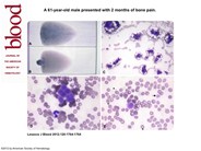 Cryoglobulin deposits on a blood smear