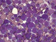 Pure erythroid leukemia