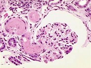 Thrombotic Thrombocytopenic Purpura - 7.