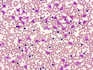 Chronic Lymphocytic Leukemia Thrombocytopenia 1.