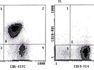 Chronic Lymphocytic Leukemia: Thrombocytopenia - 4.