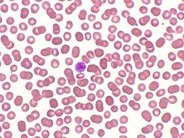 Idiopathic Thrombocytopenic Purpura - 2.