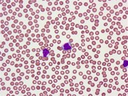 Idiopathic Thrombocytopenic Purpura - 4.