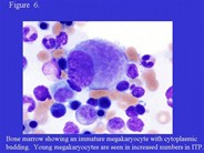 Idiopathic Thrombocytopenic Purpura - 6.