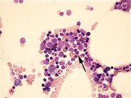 Follicular lymphoma - aspirate