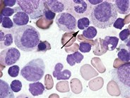 Follicular lymphoma aspirate