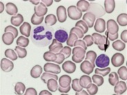 Follicular lymphoma - aspirate