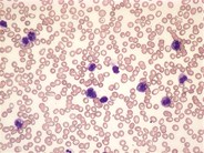 Mast cell leukemia