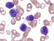 Mast cell leukemia