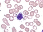 Mast cell leukemia