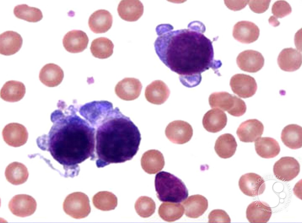 Acute Megakaryoblastic Leukemia - 1.
