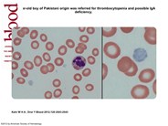 Gray platelet syndrome: macrothrombocytopenia with deficient a-granules