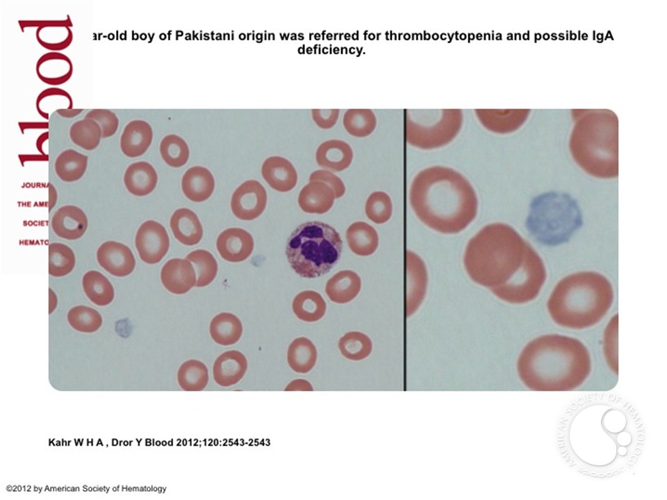 Gray platelet syndrome: macrothrombocytopenia with deficient a-granules