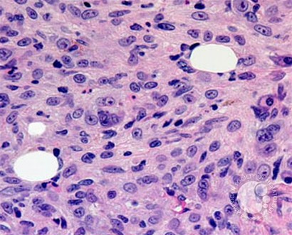 Acute Megakaryoblastic Leukemia - 3.