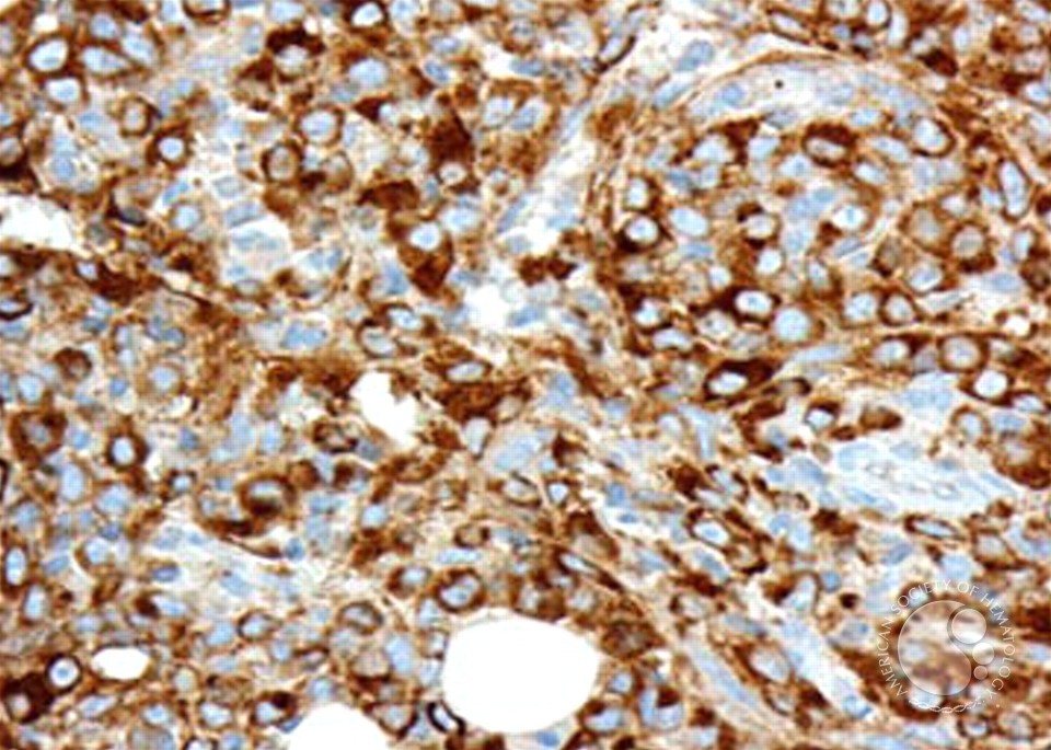 Acute Megakaryoblastic Leukemia - 4.
