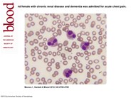 Reactive eosinophilia and thrombosis