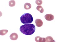 Precursor T-Lymphoblastic Leukemia/Lymphoma - 1.