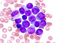 Precursor T-Lymphoblastic Leukemia/Lymphoma - 2.