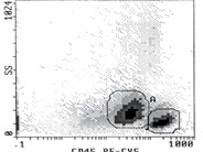 Precursor T-Lymphoblastic Leukemia/Lymphoma - 3.