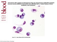 Cerebrospinal fluid plasmacytosis