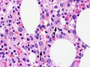 Myeloid Neoplasms Myelodysplastic Syndrome Refractory Ctyopenia With