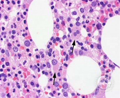 Myeloid Neoplasms. Myelodysplastic Syndrome: Refractory Ctyopenia with Multilineage Dysplasia - 4.