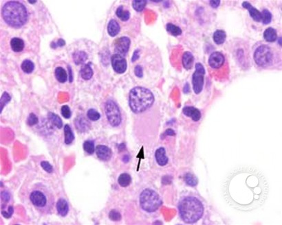 Myeloid Neoplasms. Myelodysplastic Syndrome: Refractory Ctyopenia with Multilineage Dysplasia - 5.