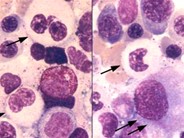 myeloid-neoplasms-myelodysplastic-syndrome-refractory-ctyopenia-with