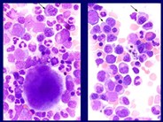 myelodysplastic syndrome