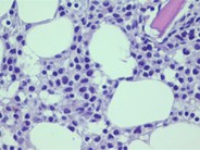 Bone Marrow Biopsy in Hairy Cell Leukemia : The fried egg appearance