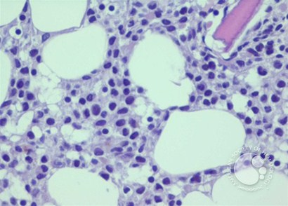 Bone Marrow Biopsy in Hairy Cell Leukemia : The fried egg appearance