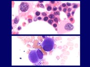 Myelodysplastic Syndrome: Myelodysplastic Syndrome Associated with Isolated del(5q)Chromosome Abnormality ('5q- Syndrome') - 4.