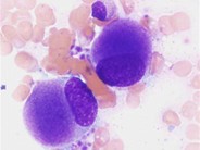 Myelodysplastic Syndrome: Myelodysplastic Syndrome Associated with Isolated del(5q)Chromosome Abnormality ('5q- Syndrome') - 5.