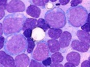 Blast Crisis of Chronic Myelogenous Leukemia - 4.